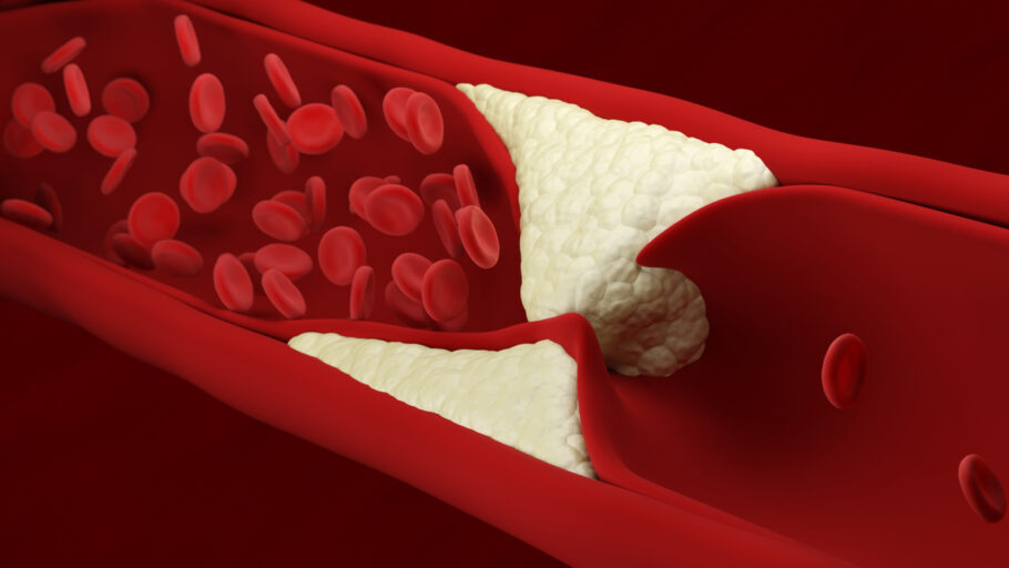 Conheça um sinal pouco conhecido de colesterol alto