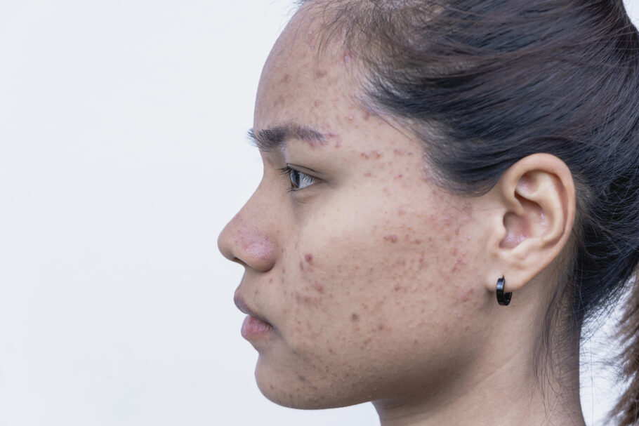 Teste sugere que remédio para pressão alta reduz acne severa