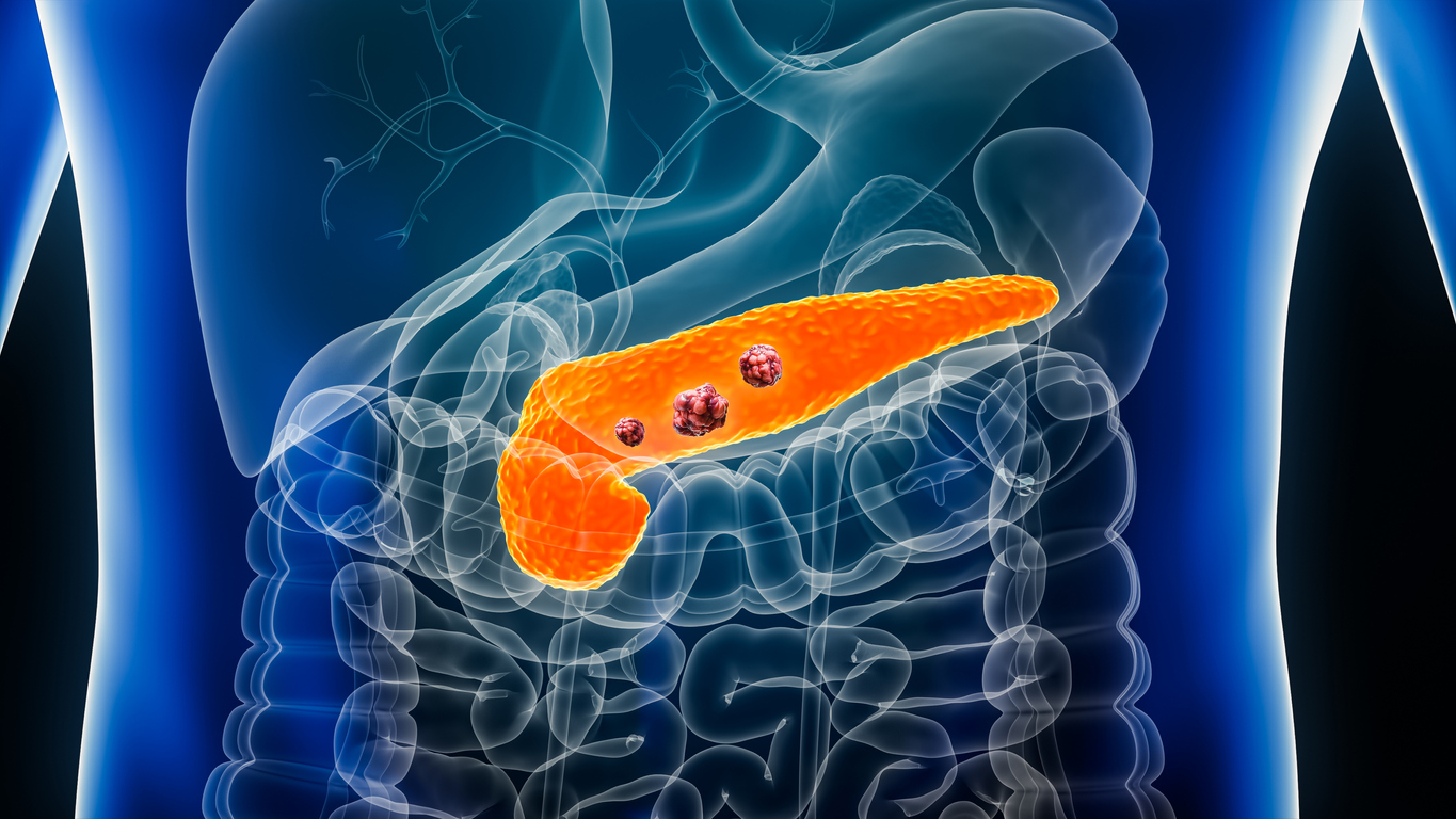 Sintomas de câncer de pâncreas podem ser inespecíficos no início