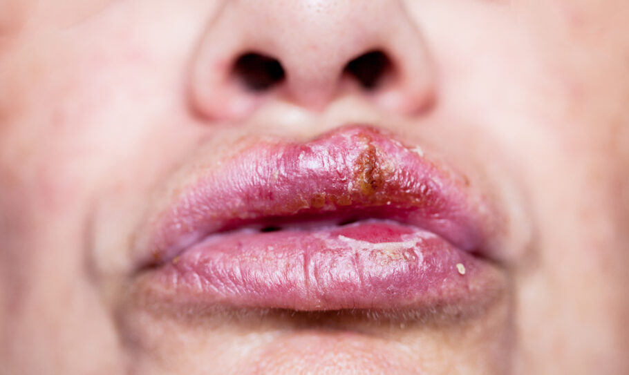 Feridas na boca podem ser sinal de Infecção sexualmente transmissível