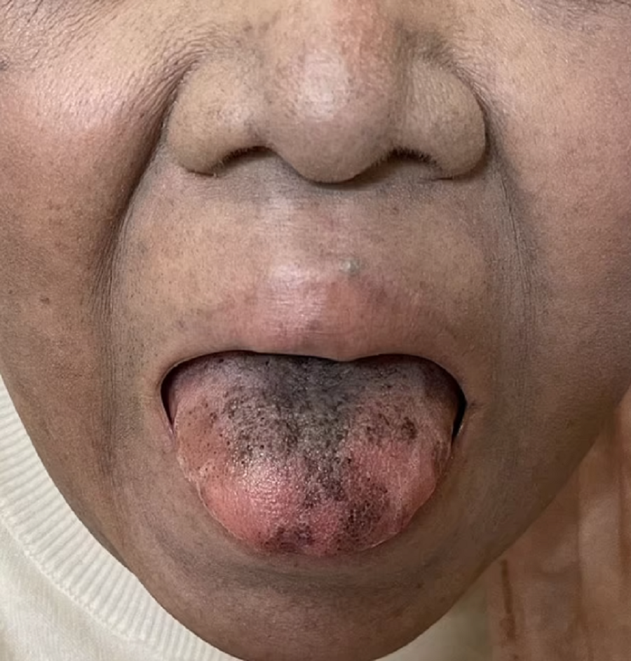 Mulher fica com a língua preta por reação a antibiótico