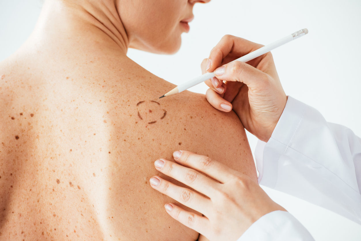 Câncer de pele é o mais frequente no Brasil e corresponde a cerca de 30% de todos os tumores malignos registrados no país.