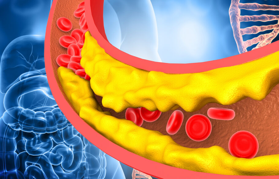 Ilustração mostra artérias com acúmulo de gordura do colesterol