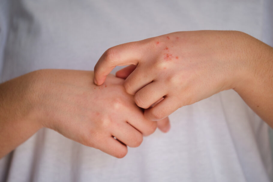 Às vezes o câncer de pele nas mãos pode se assemelhar a verrugas ou feridas abertas que não cicatrizam completamente