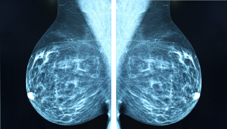 Medicamento reduz risco de retorno de câncer de mama