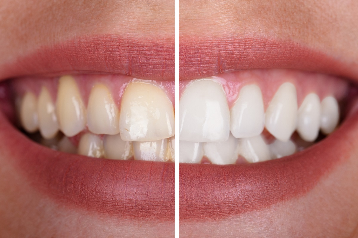 Estas são as dicas para deixar os dentes brancos