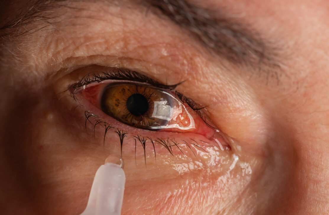Causas da síndrome do olho seco