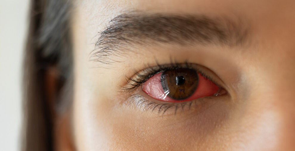 Sintomas da Síndrome do olho seco