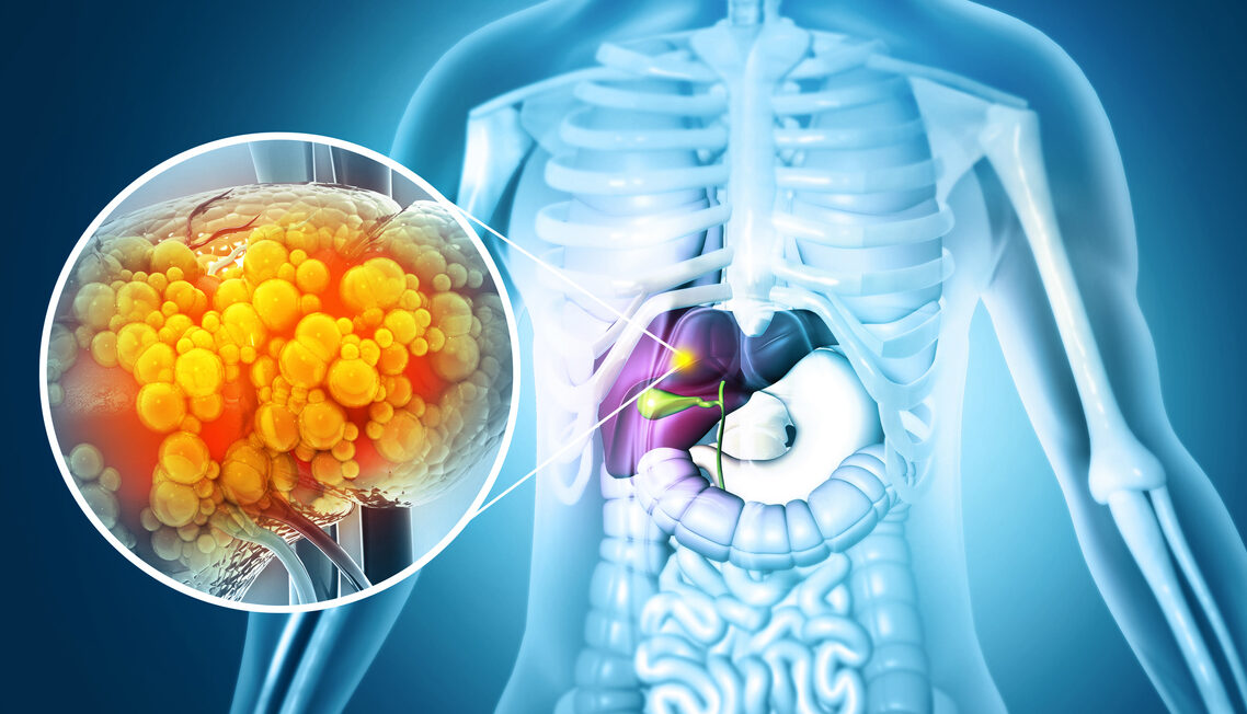 Câncer de fígado pode ser confundido com indigestão