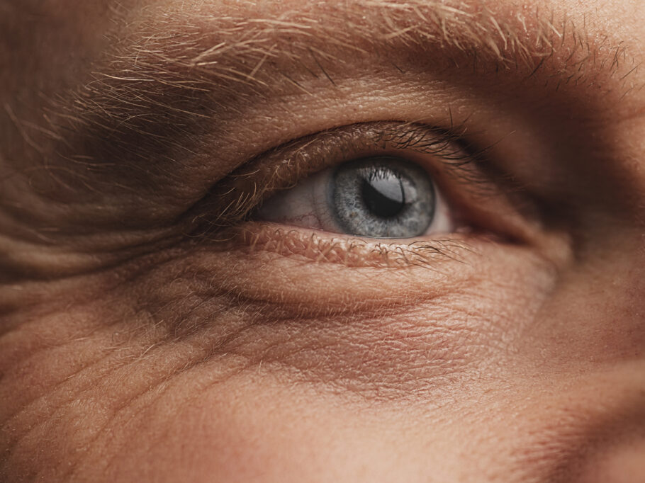 Arco no olhos pode ser sinal de colesterol extremamente alto