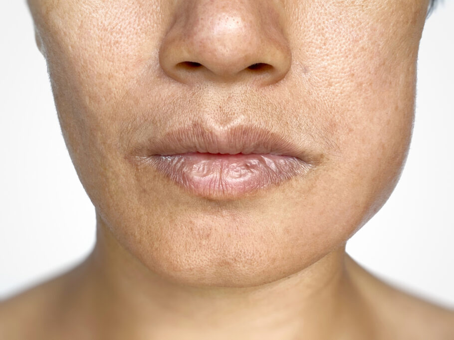 A cor dos lábios pode desaparecer em casos de anemia