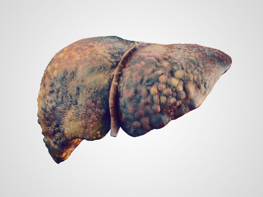 A cirrose reduz a capacidade do fígado de funcionar adequadamente