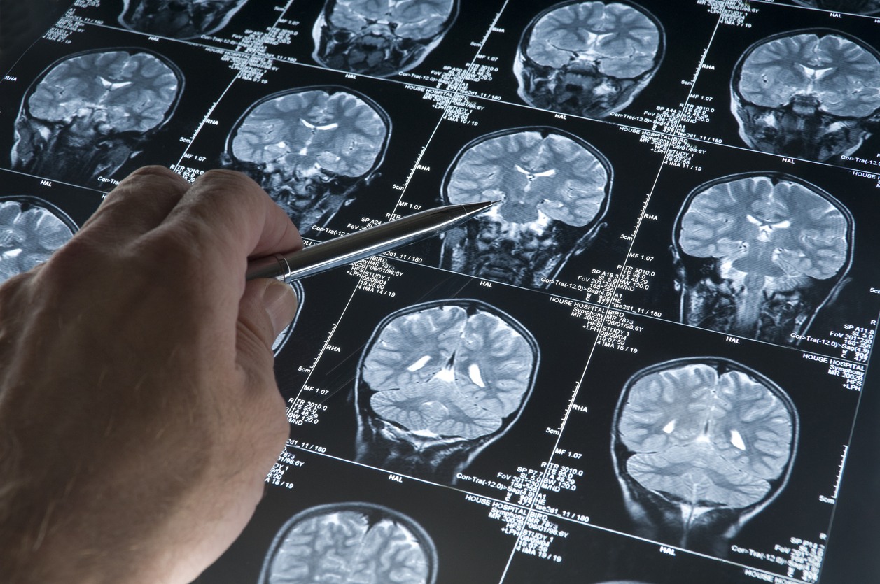 O estudo descobriu que o novo exame poderia identificar pessoas com probabilidade intermediária e improvável de desenvolver o Alzheimer – iStock/Getty Images