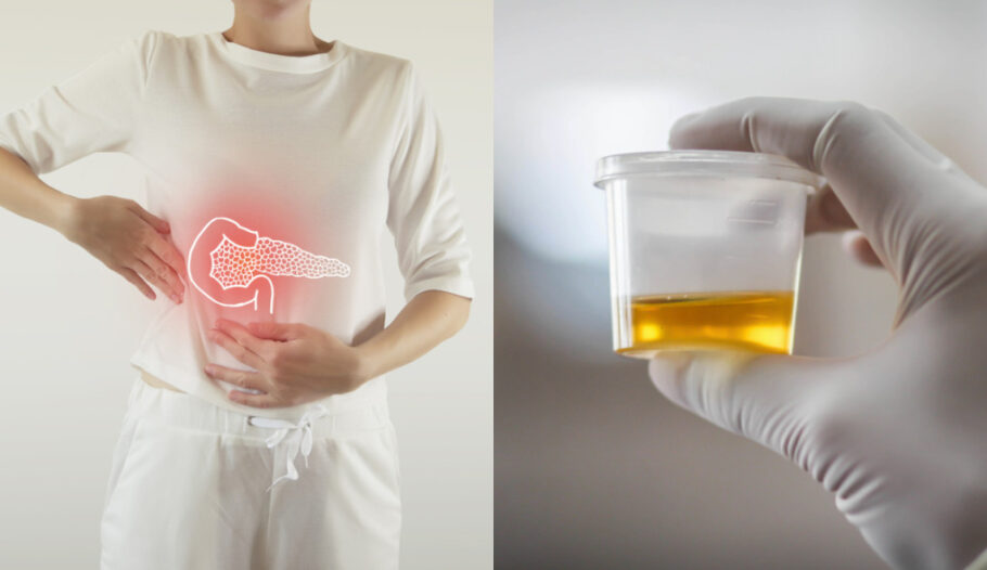 Urina mais escura pode ser sinal de câncer de pâncreas