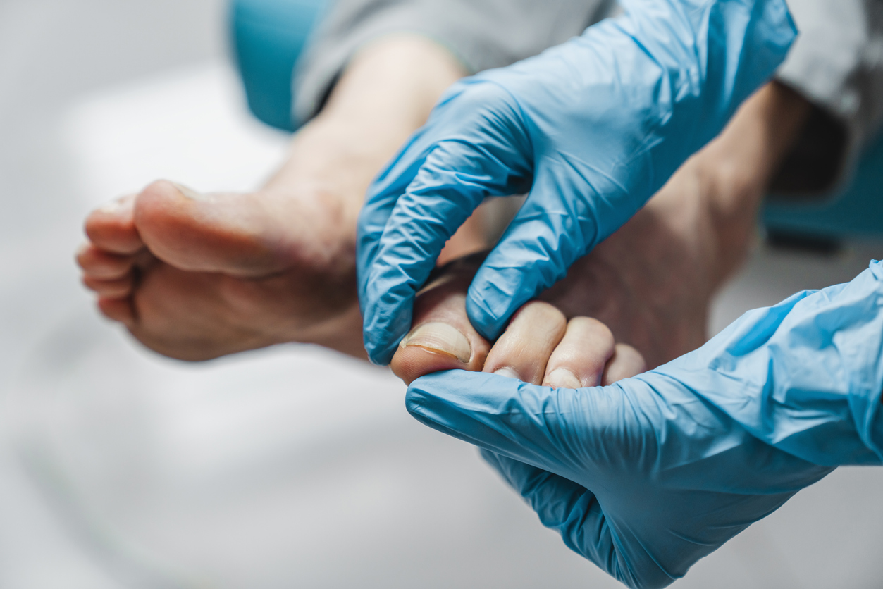 Produtos à base de – pantenol ou pró-vitamina B5, que fortalecem unhas fracas e quebradiças, são boas opções de tratamento para as manchas brancas na unha – iStock/Getty Images