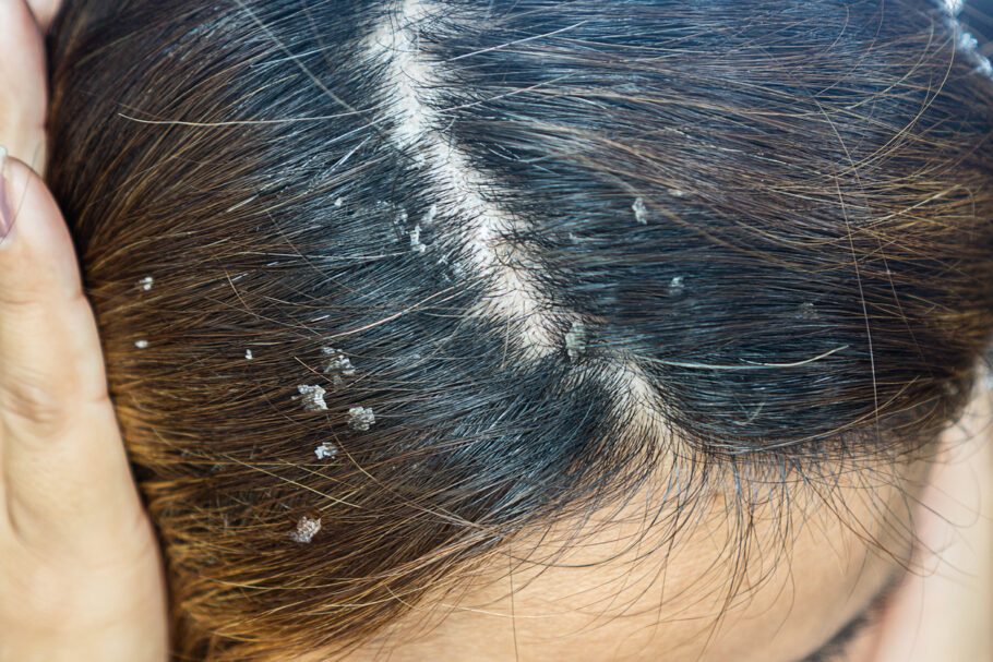 Conheça alguns dos principais sinais de câncer no couro cabeludo