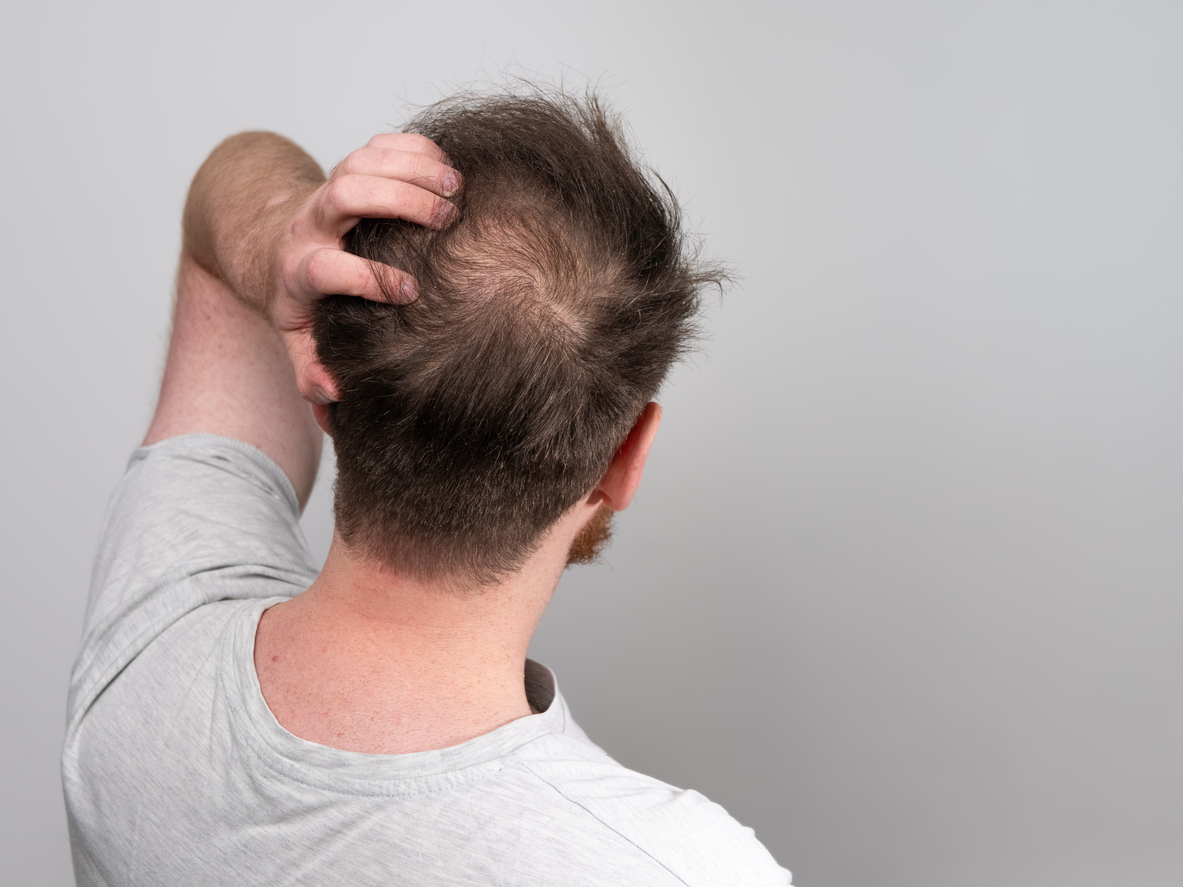 Queda de cabelo: diariamente, uma pessoa saudável perde entre 50 e 200 fios, apontam especialistas – iStock/Getty Images