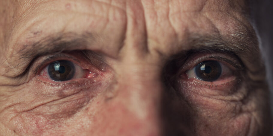 Sinais nos olhos podem ser indicadores de colesterol alto