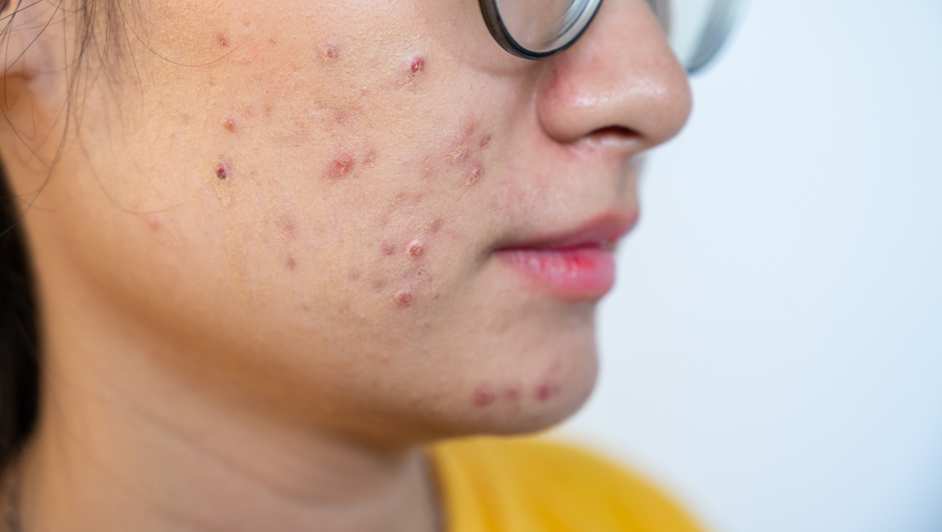 Como a alimentação pode ajudar a melhorar a acne?