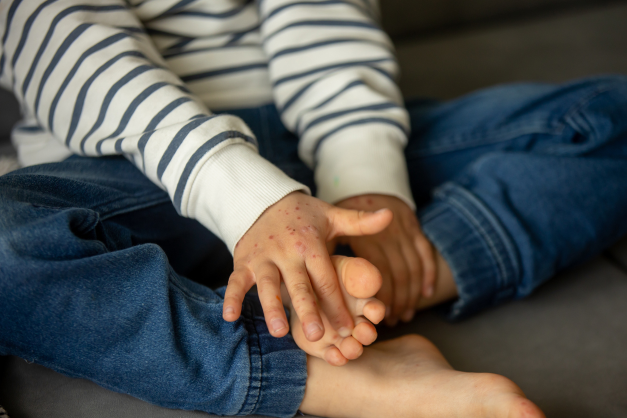 Síndrome Mão-Pé-Boca preocupa pais e mães