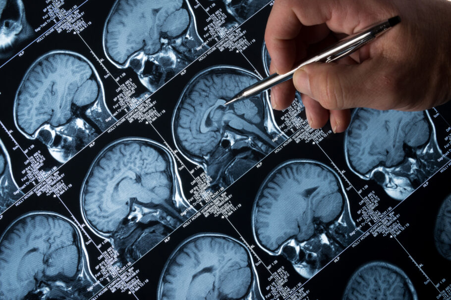 Remédio experimental reduz a progressão do Alzheimer