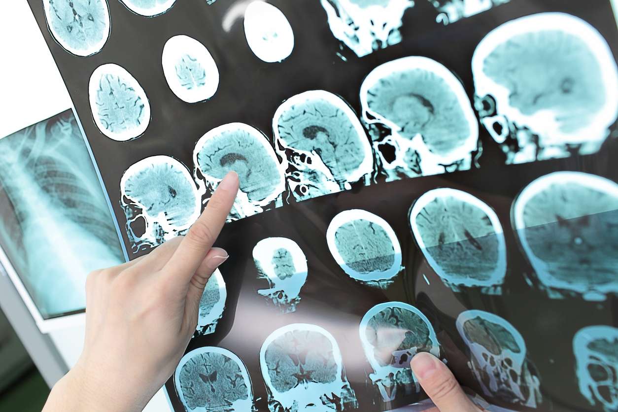 Novo exame de Alzheimer promete incluir pacientes de populações historicamente negligenciadas pelos avanços da medicina – iStock/Getty Images