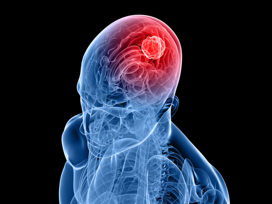 Tumor cerebral pode causar perda de paladar