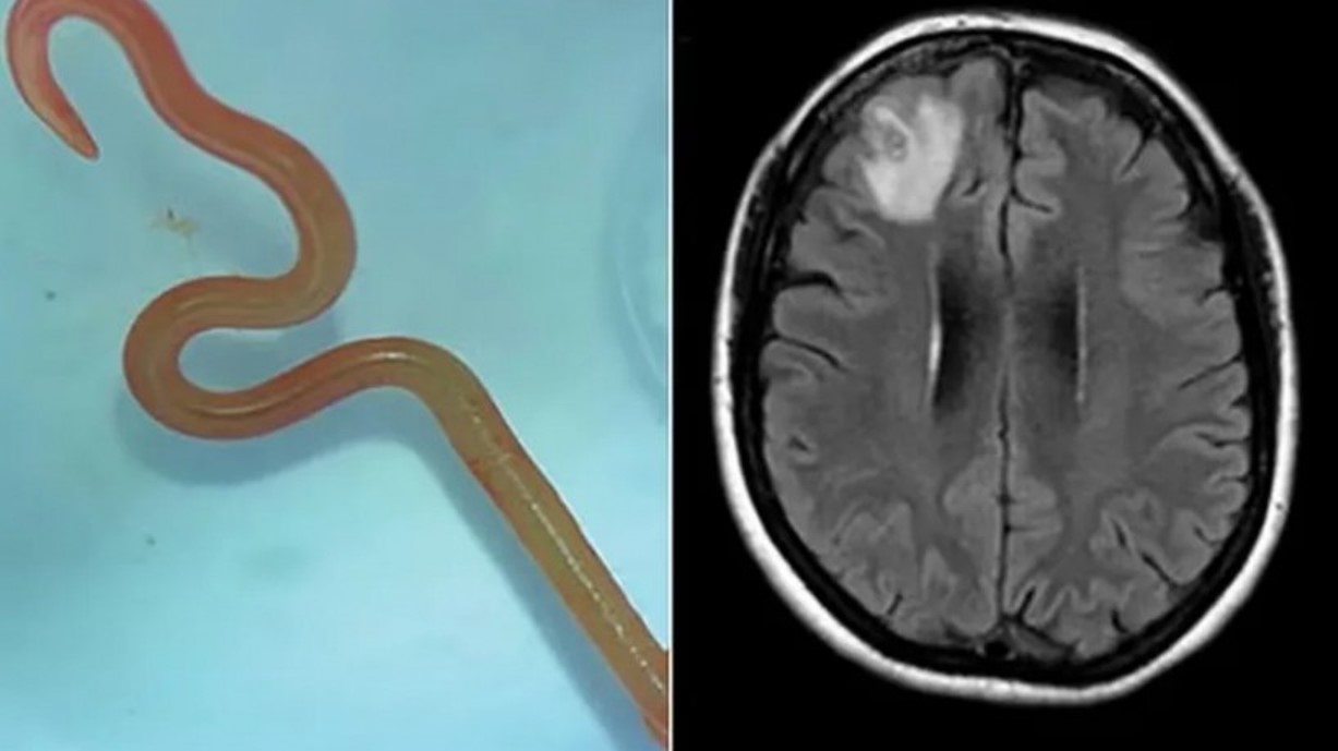 Verme parasita de cobras é encontrado pela 1ª vez em cérebro humano
