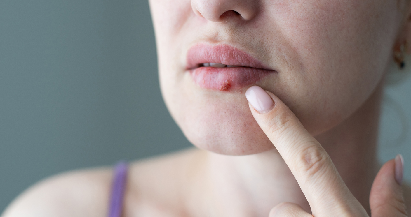 Sinais nos lábios que podem indicar doenças para você se atentar