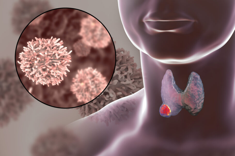 Nódulo costuma ser o primeiro sinal de câncer de tireoide
