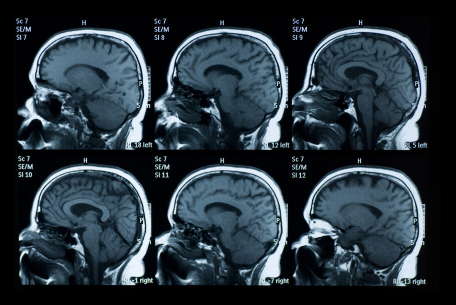 Autópsias cerebrais sugerem um nova causa do Alzheimer