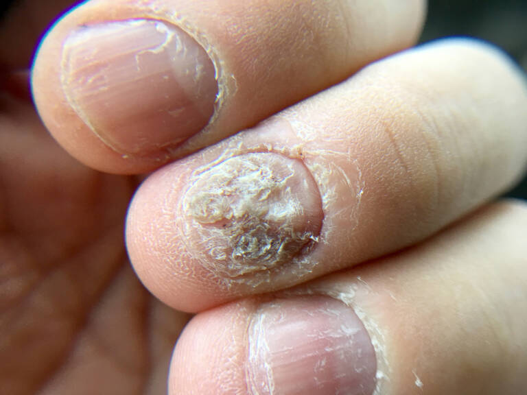 Sinais de psoríase nas unhas e como diferenciála de micose