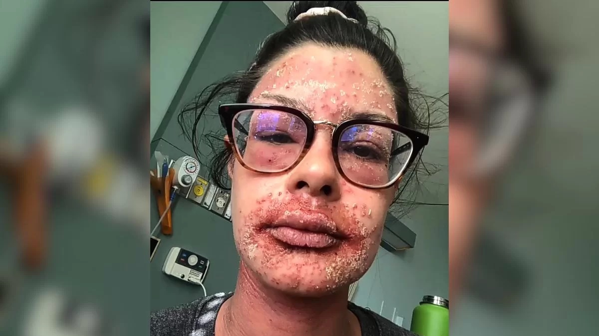Mulher relata experiência traumática com uso de creme para eczema