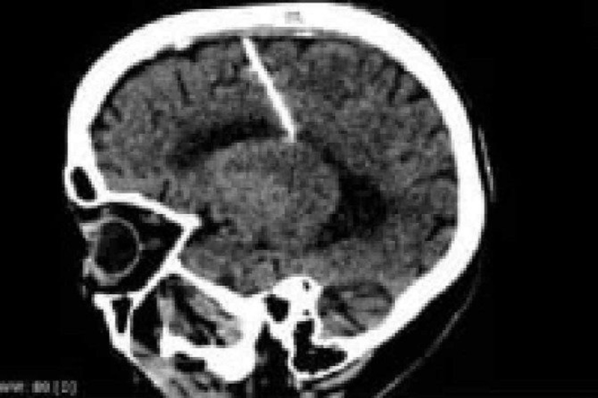 Idosa descobre agulha em seu cérebro após exame de tomografia