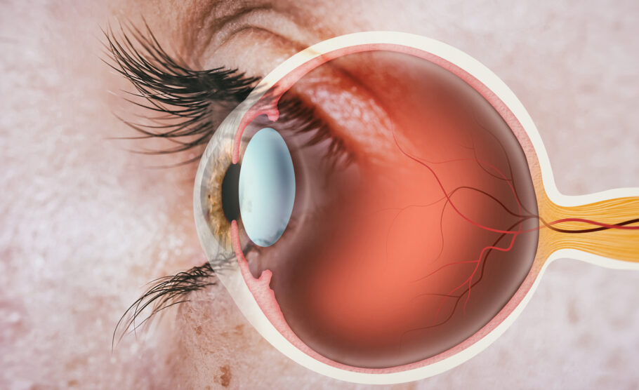 Conheça os sinais e o que provoca descolamento de retina