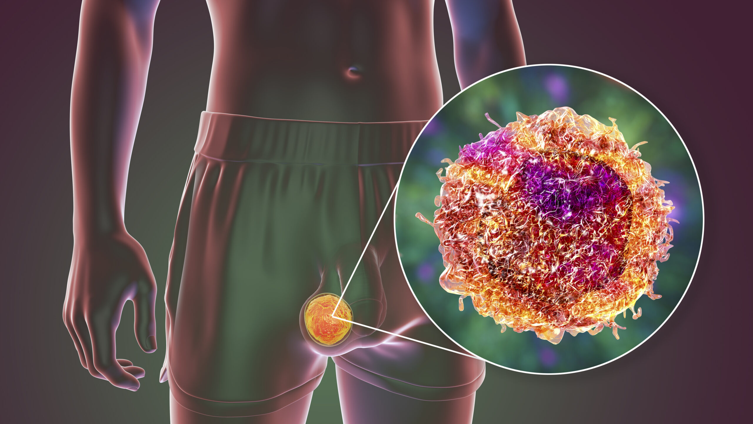 Conheça os sintomas do câncer de testículo