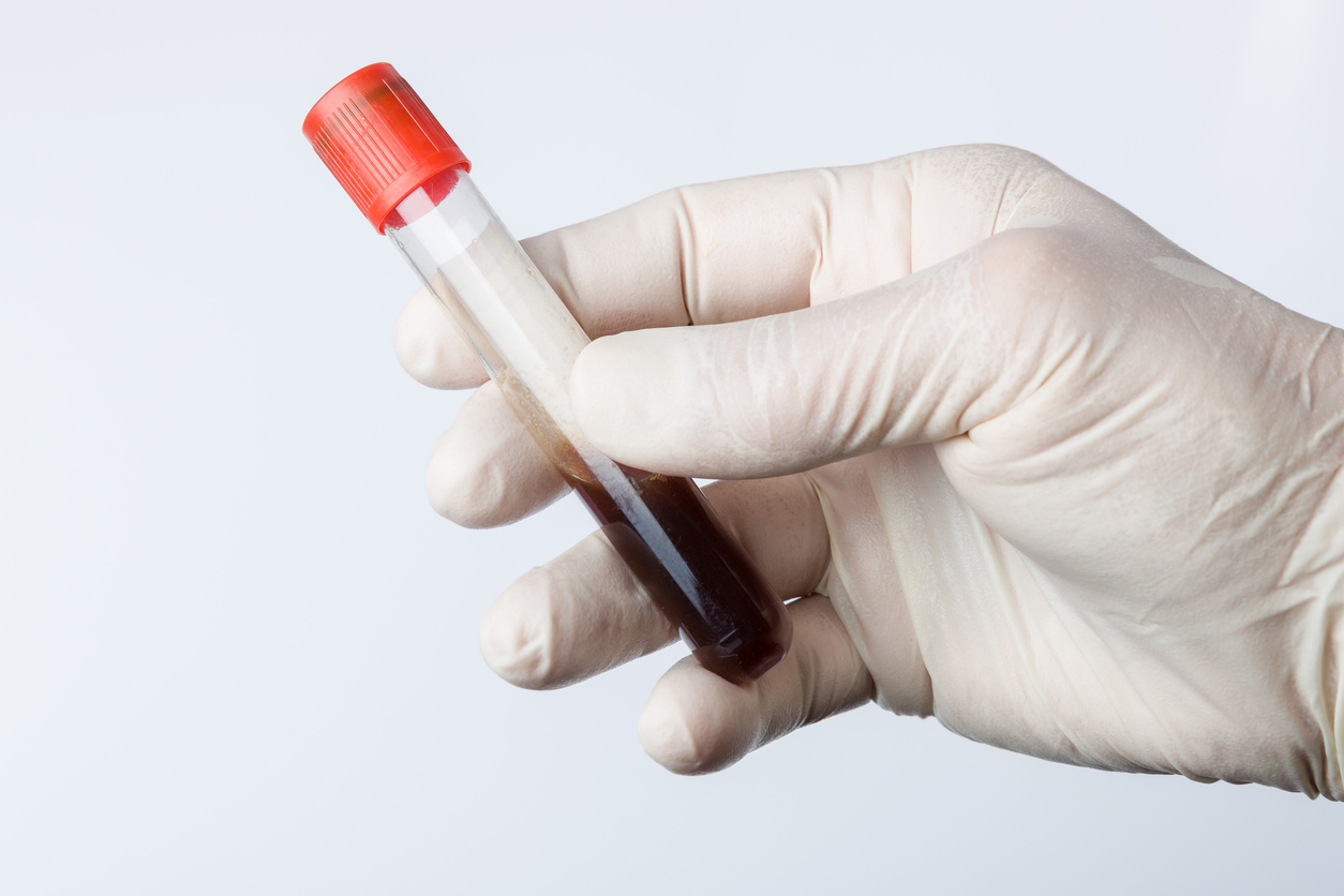 Novo exame de sangue detecta 50 tipos de câncer antes dos sintomas – mbz-photodesign/istock