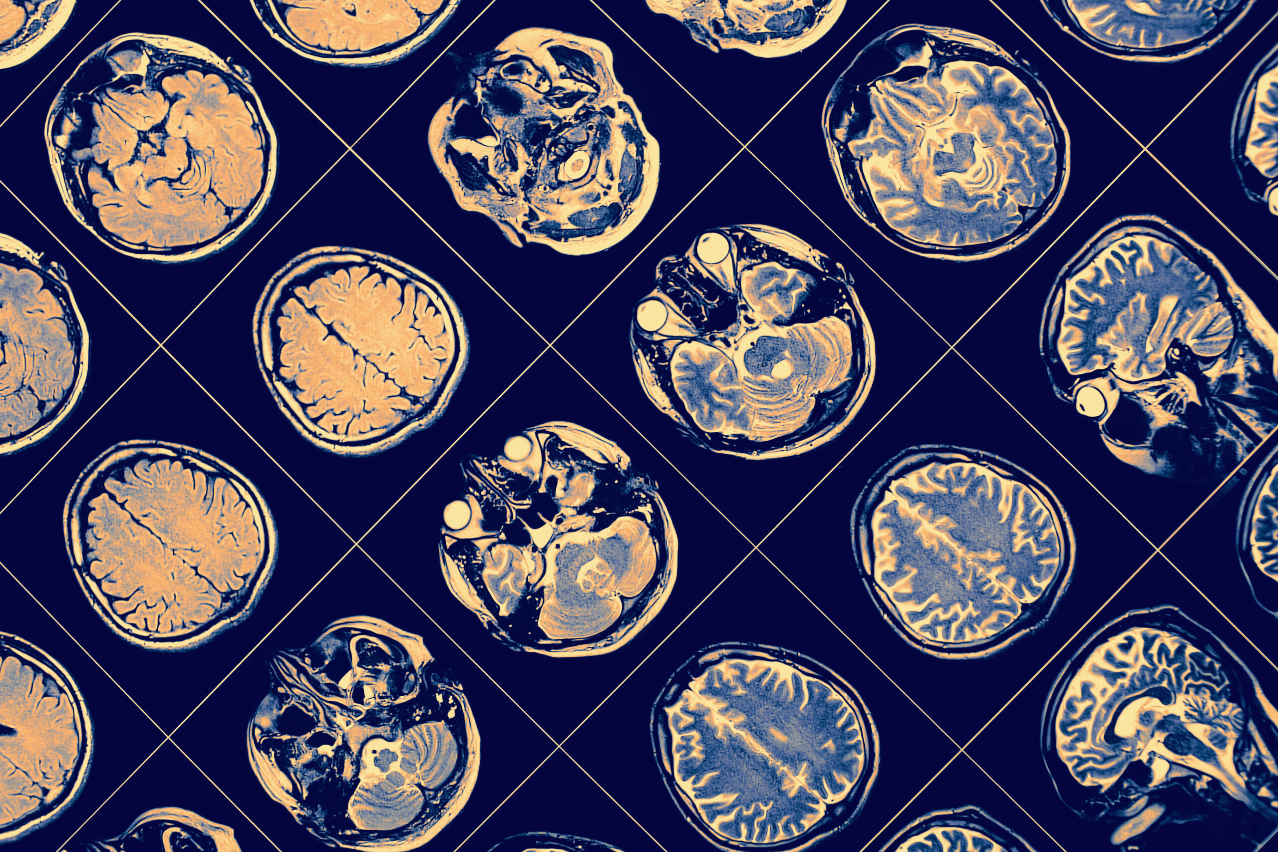 Estudo descobre como bandana pode detectar os primeiros sinais de Alzheimer
