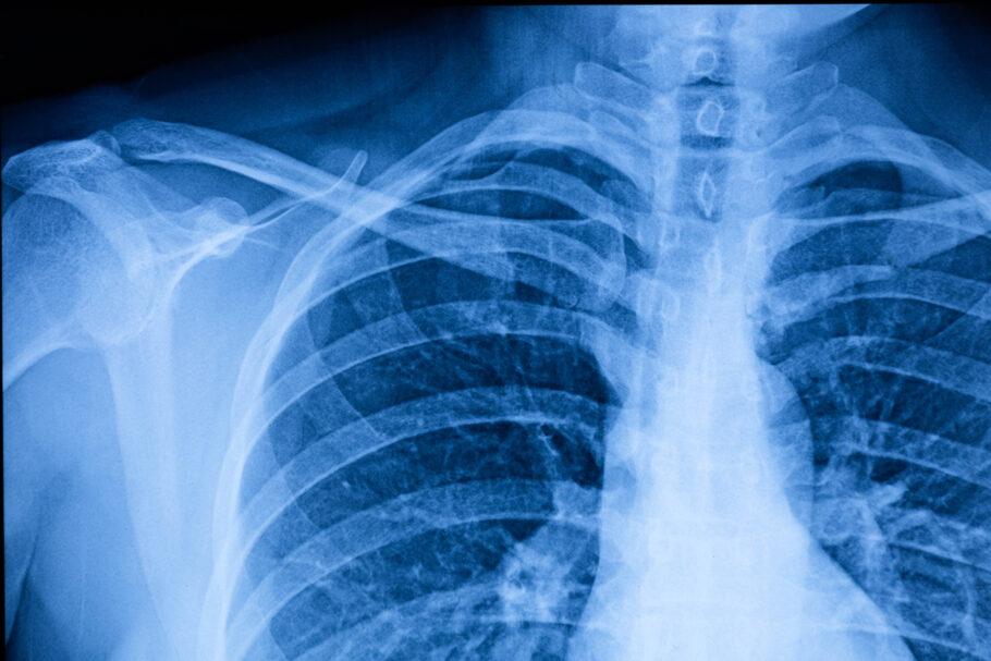 Epidemia misteriosa na China provoca febre com nódulos nos pulmões