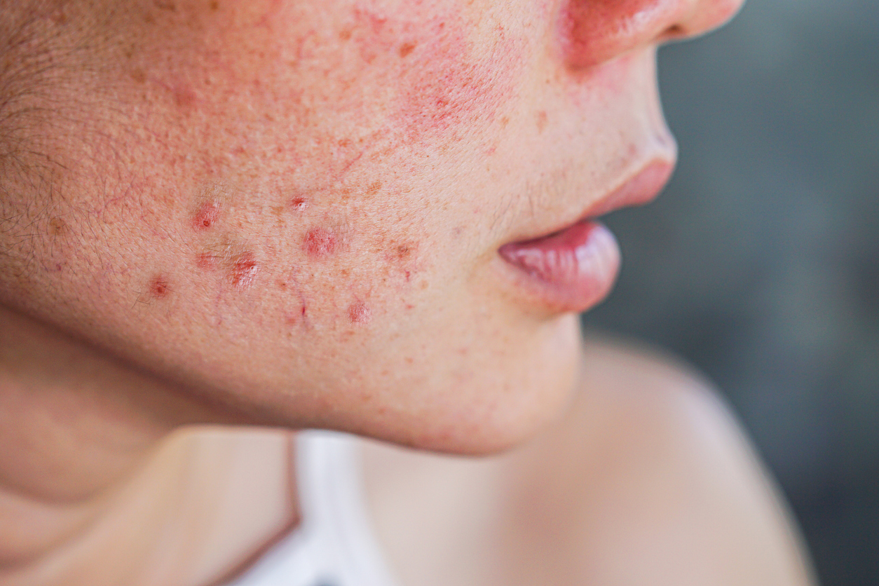 Fatores genéticos têm impacto significativo para o surgimento de acne em mulheres após os 25 anos – iStocvk/Getty Images