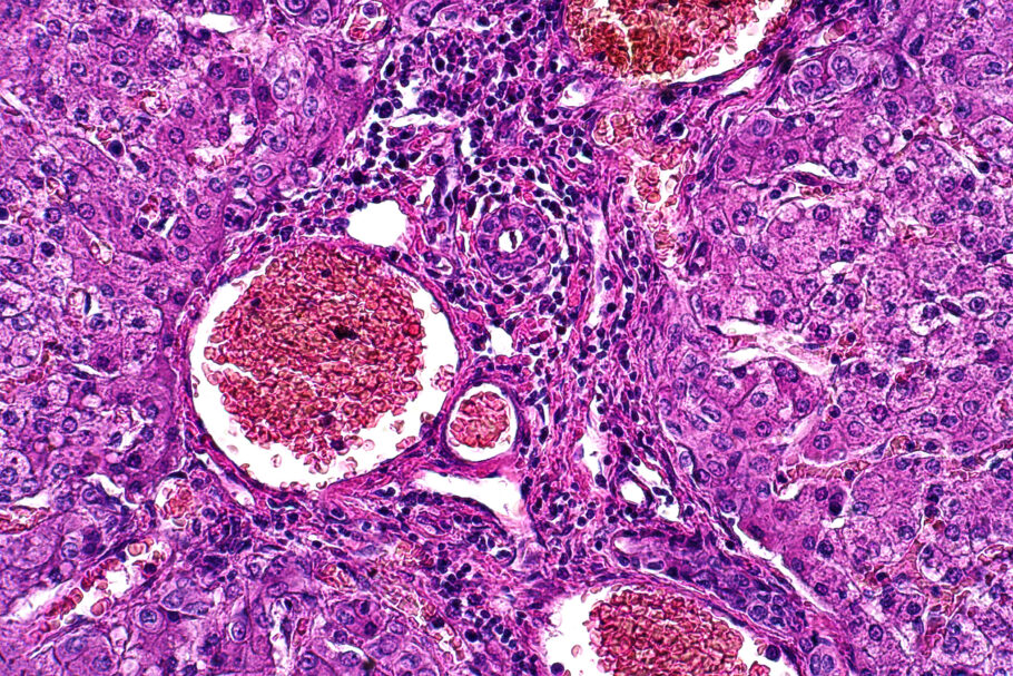 Cientistas descobriram uma maneira de explodir as “portas” das células cancerígenas pela primeira vez