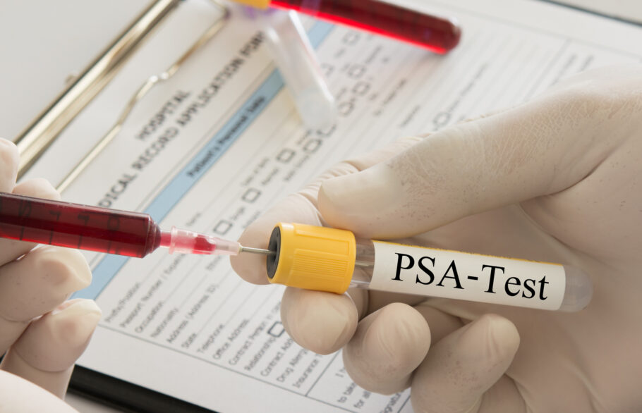 O  teste de PSA é um exame de sangue usado para medir os níveis de uma proteína produzida pelas células da próstata, na corrente sanguínea