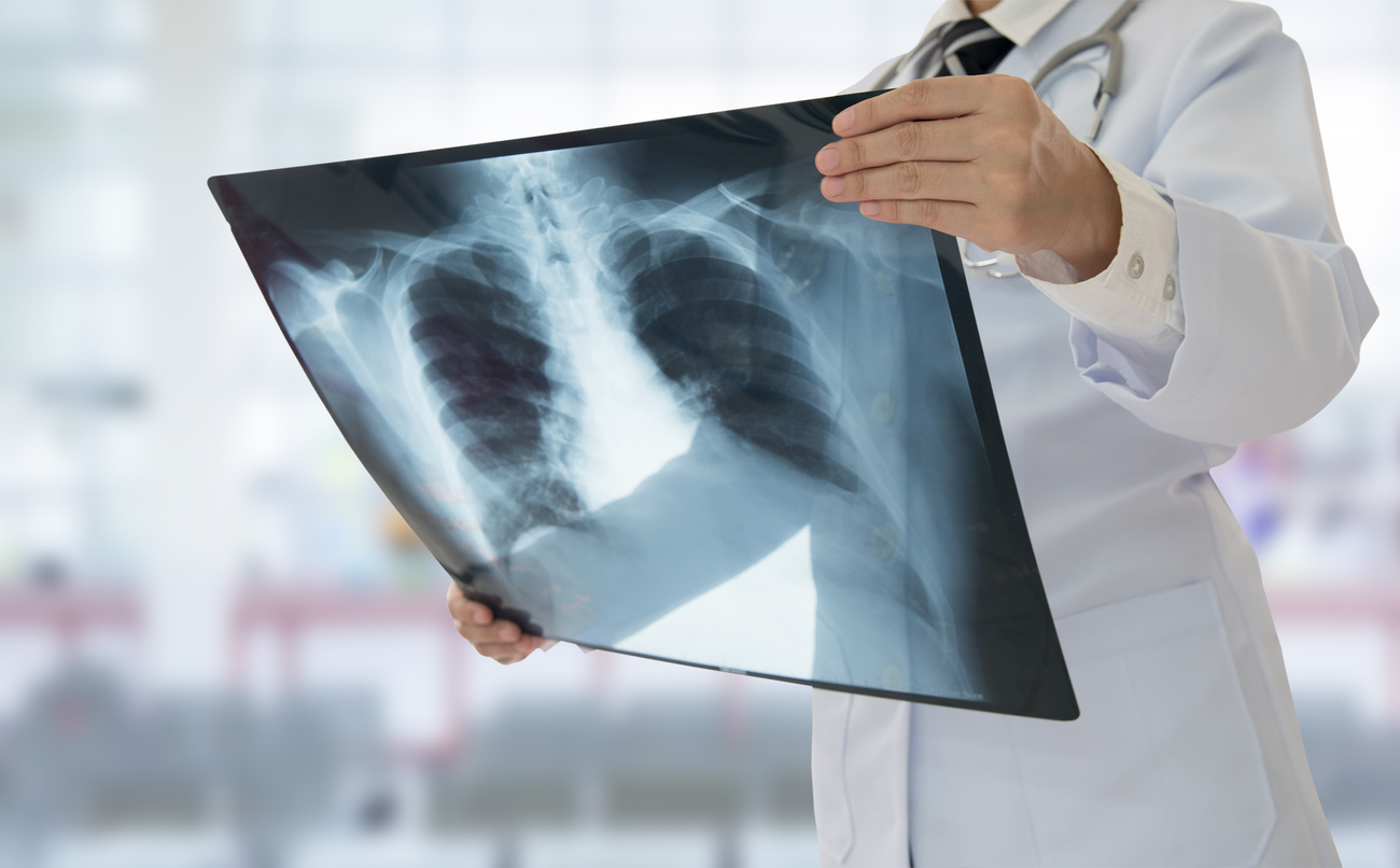 O câncer de pulmão, de acordo pesquisas sobre o tema, pode apresentar uma variedade de sintomas iniciais, que variam de pessoa para pessoa – iStock/Getty Images