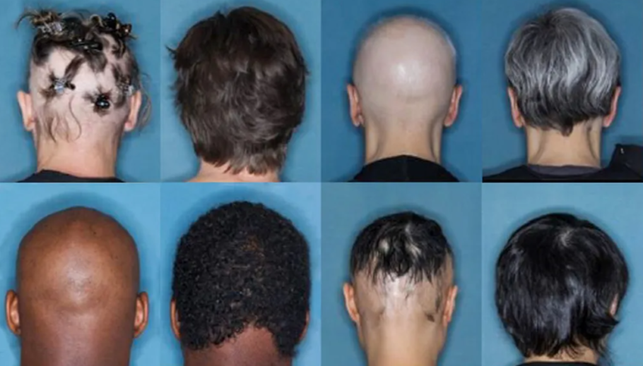 Remédio aprovado pela Anvisa trata queda de cabelo causado por alopecia areata