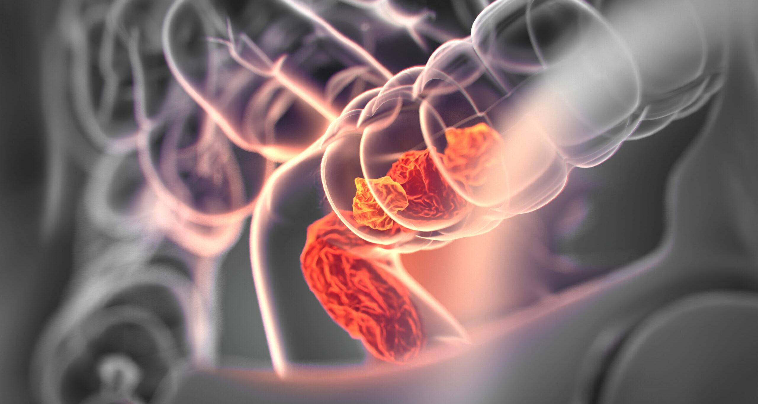 Folato pode diminuir o risco de câncer de intestino em até 7%