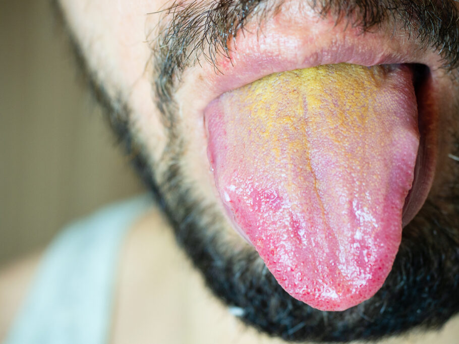A cor da língua pode sofrer alterações quando há problemas de saúde ou higiene