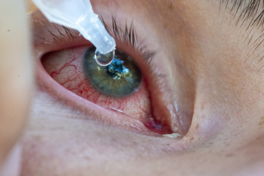 Clamídia nos olhos causa sintomas semelhantes aos da conjuntivite