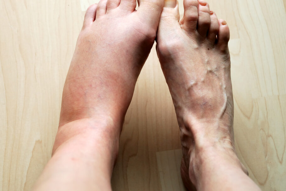 Há situações em que o inchaço nos pés pode ser um sinal de um problema médico mais sério