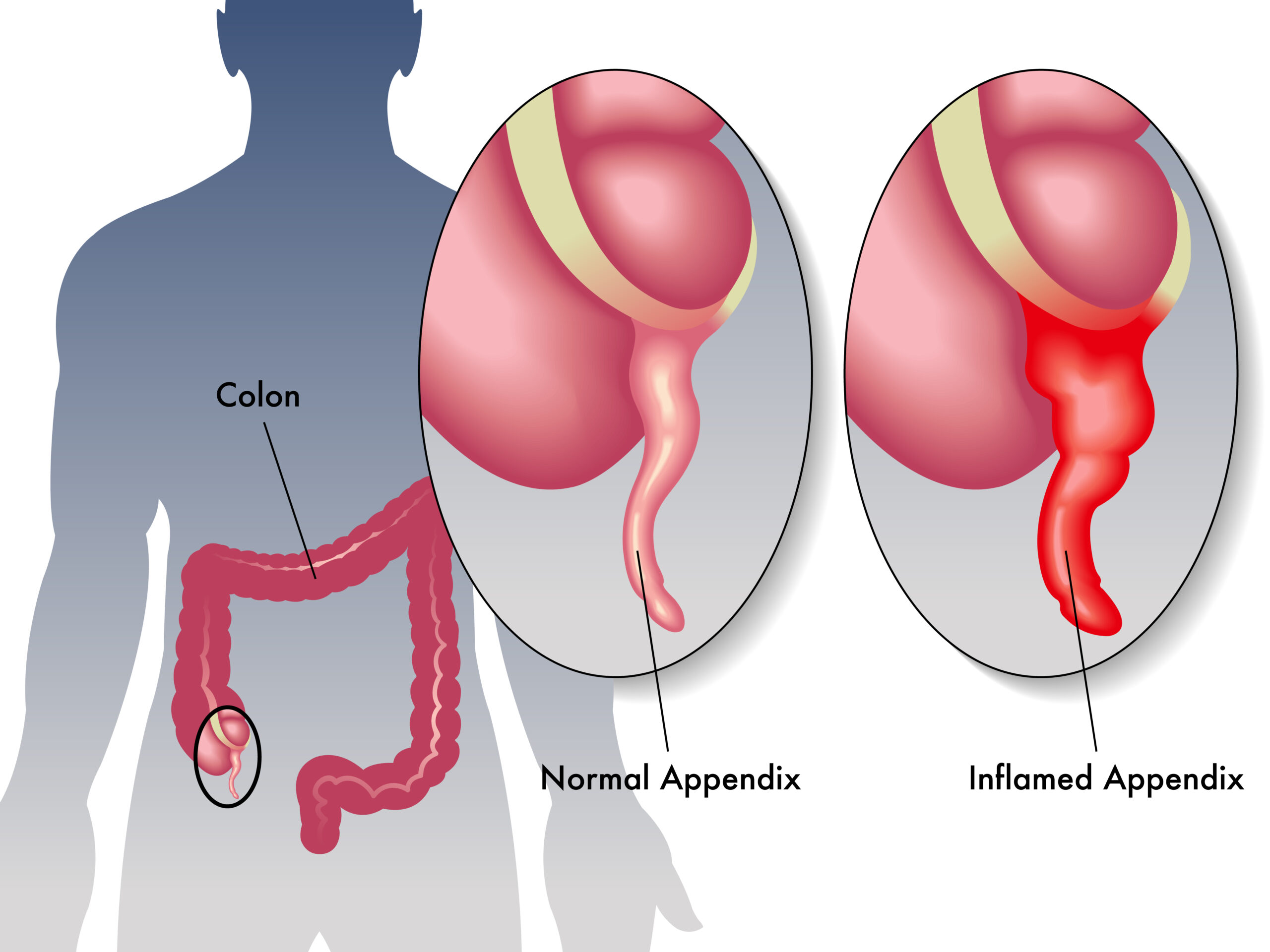 Ilustração da inflamação do apêndice