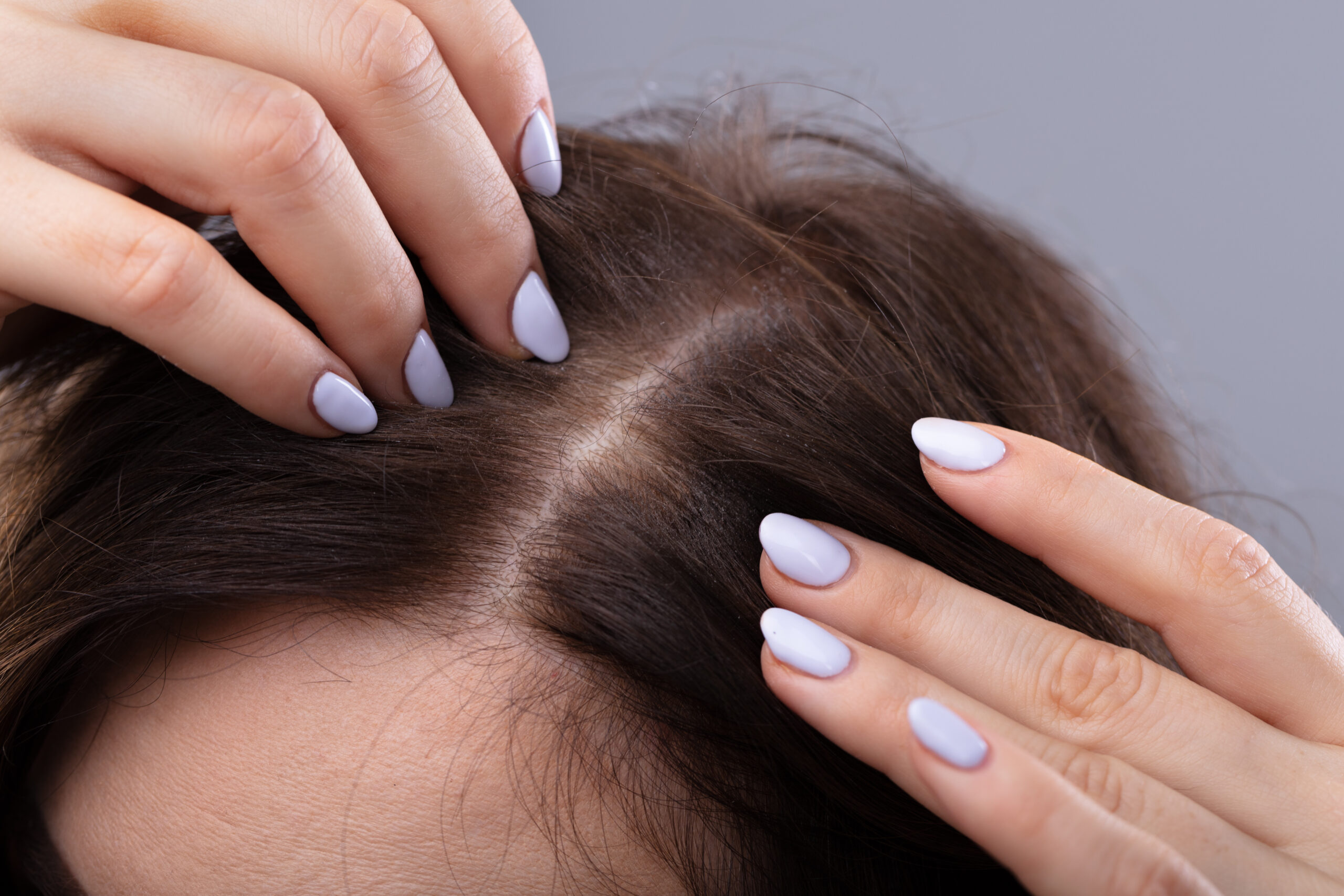 Veja como prevenir câncer de pele no couro cabeludo